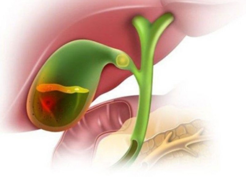 Как изменилось качество жизни после удаления желчного пузыря